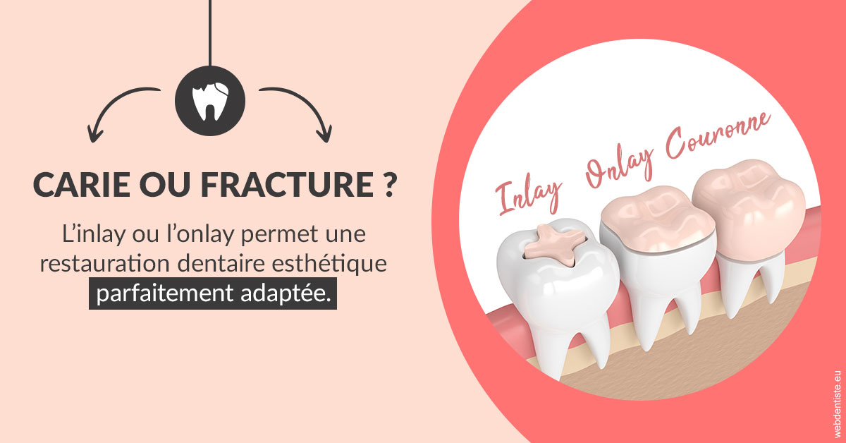 https://www.dr-hivelin-orvault.fr/T2 2023 - Carie ou fracture 2