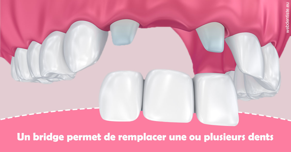 https://www.dr-hivelin-orvault.fr/Bridge remplacer dents 2