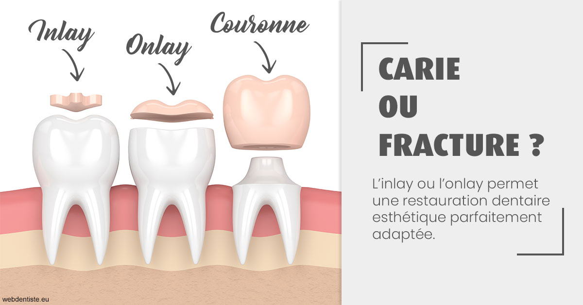 https://www.dr-hivelin-orvault.fr/T2 2023 - Carie ou fracture 1