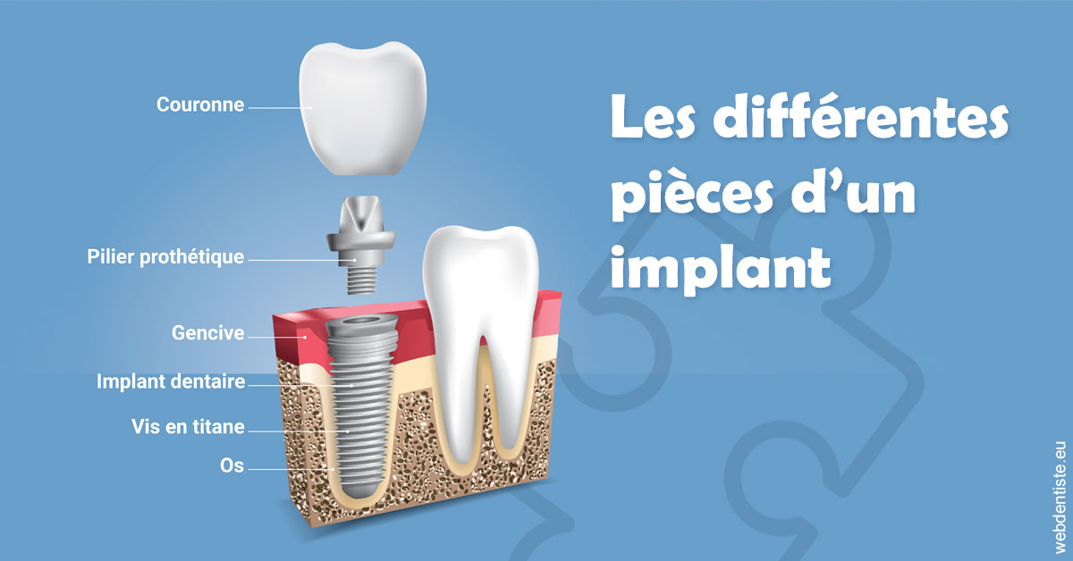 https://www.dr-hivelin-orvault.fr/Les différentes pièces d’un implant 1